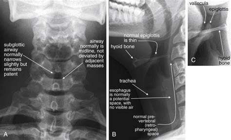normal soft tissue neck x-ray|soft tissue x ray technique.